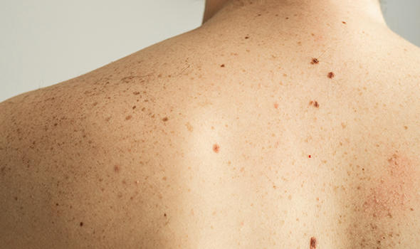 Freepik_close-up-detail-of-the-bare-skin-on-a-man-back-with-scattered-moles-and-freckles-checking-benign-moles_nastyaofly.jpg