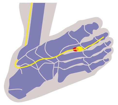 Morton-Neurom-plantar.jpg